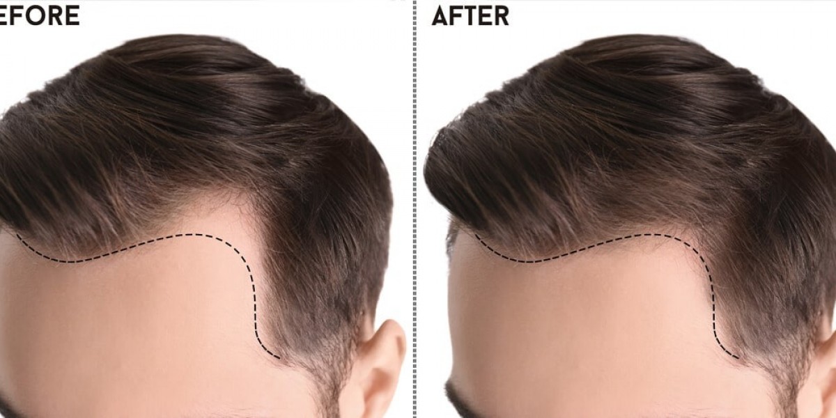 Choosing Excellence: The Quest for the Best Hair Transplant in Islamabad