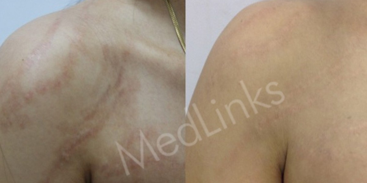 Clear Skin Begins Here: Acne Scar Treatment in Delhi by Experts at Medlinks