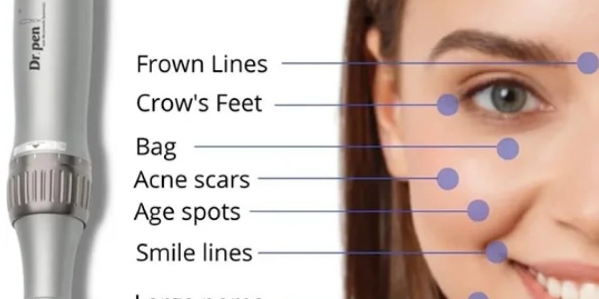 Microneedling Aknenarben: Wie Oft Sollte Man Die Behandlung Wiederholen?