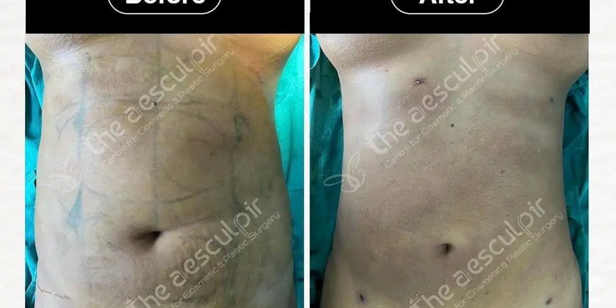 Reshape Your Body with Expert Liposuction Surgery at Theaesculpir