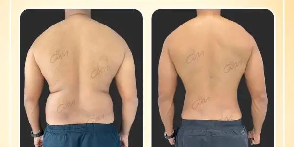 Sculpt Your Ideal Body with Liposuction in Dubai by Dr. Hans