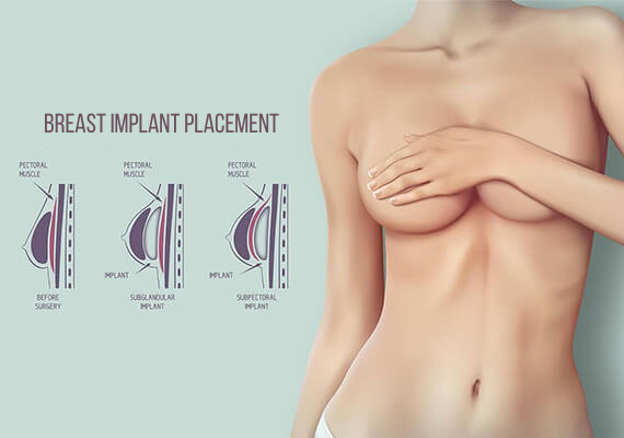 Dr. Priya Bansal provides breast augmentation in Delhi
