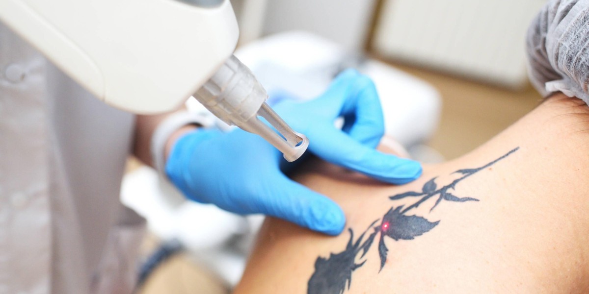 Customized Skin Solutions with Q‑Switched YAG Tattoo Removal Mississauga Technology