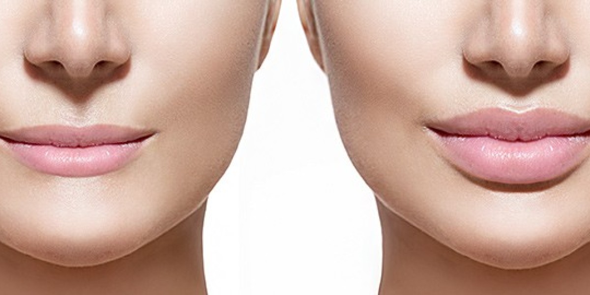 Lip Fillers in Delhi: Everything You Need to Know