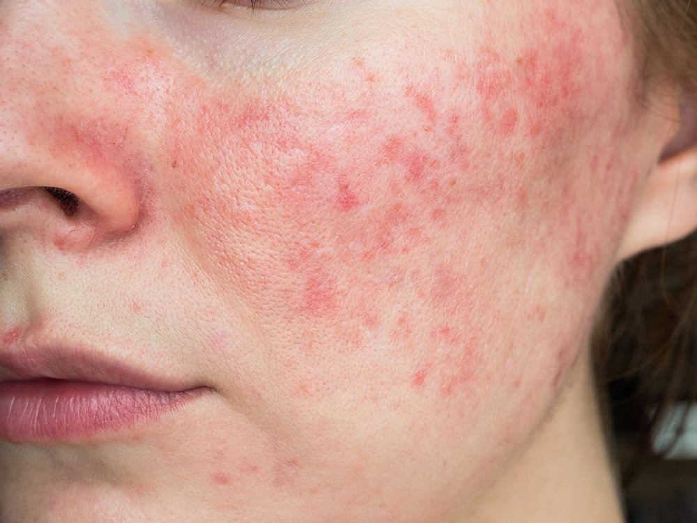 Laser Treatment for Rosacea| Get Redness & Flare-Up Control
