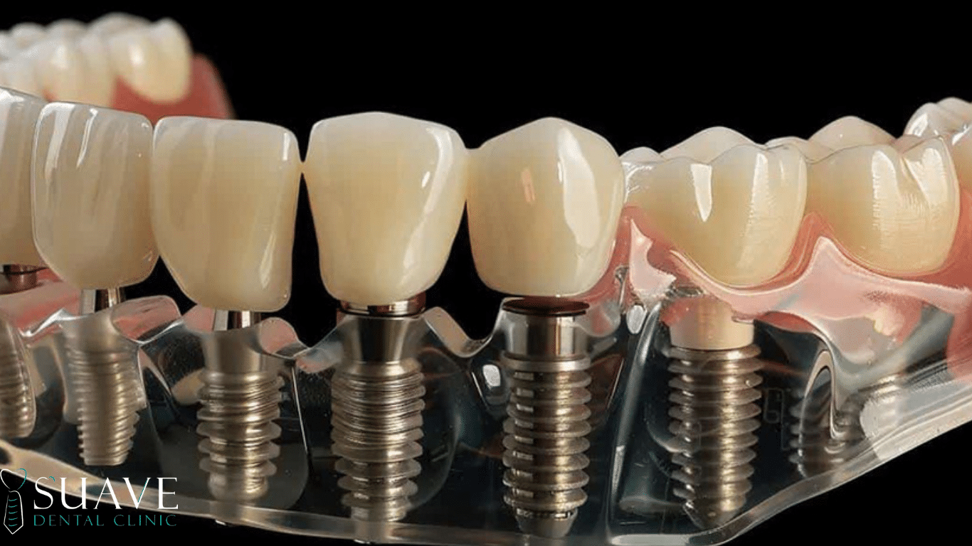 Top 6 best affordable dental implants in Turkey in 2025