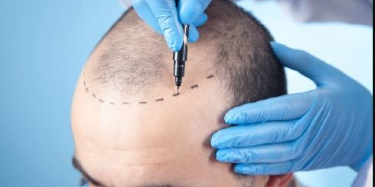 The Emotional Benefits of Hair Restoration