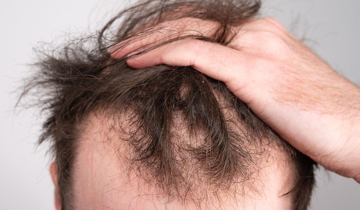 Hair Loss Treatment - Winsome