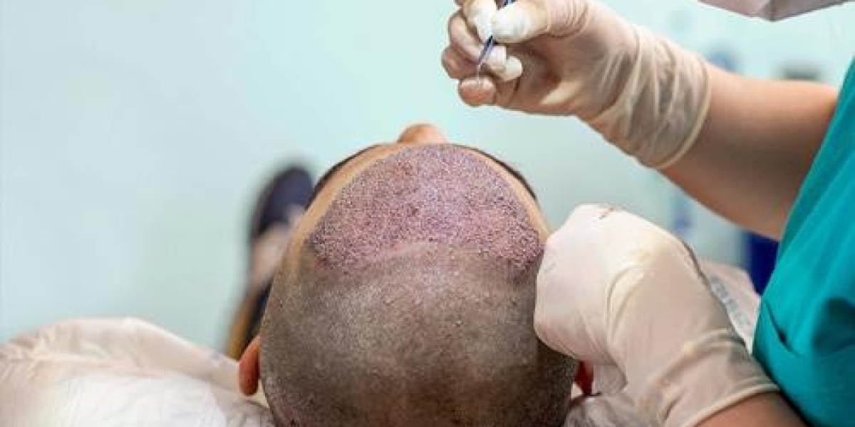 Hair Transplant in Gurgaon: Procedure, Cost, Benefits and Recovery